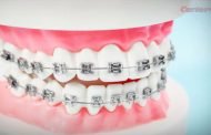 Posesor de aparat dentar? Ce intervenții poți face și cum să-l întreții